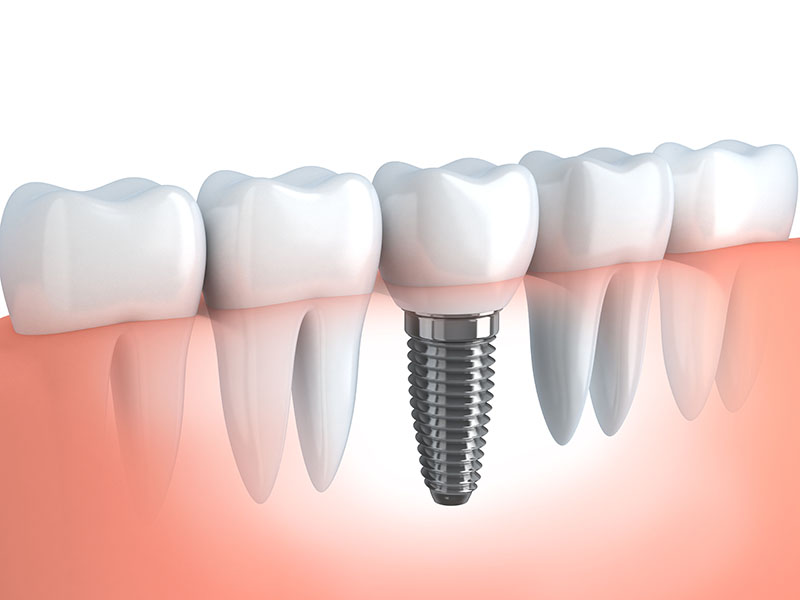 Implantologie, Zahnmedizin - Zahnheilkunde Lohmar